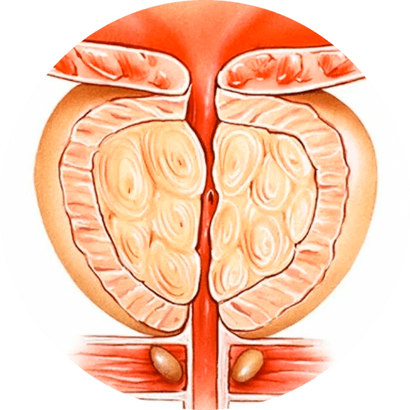 Folgen einer unbehandelten Prostatitis