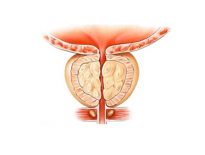 Behandlung von Prostatitis mit Volksheilmitteln